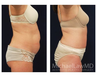 Abdominoplasty - Tummy Tuck