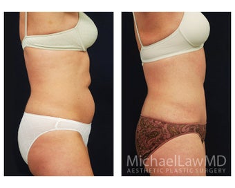 Abdominoplasty - Tummy Tuck