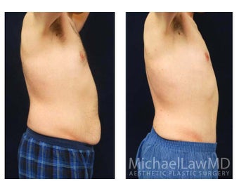Abdominoplasty - Tummy Tuck