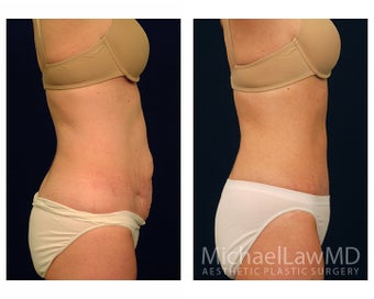 Abdominoplasty - Tummy Tuck