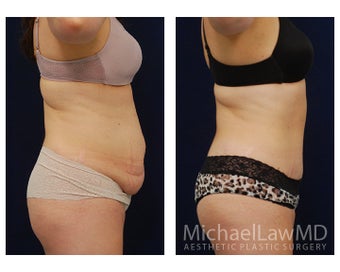 Abdominoplasty - Tummy Tuck