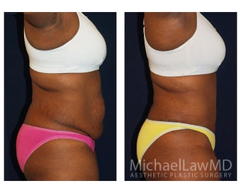 Abdominoplasty - Tummy Tuck