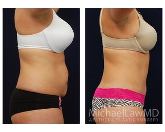 Abdominoplasty - Tummy Tuck