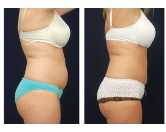 Abdominoplasty - Tummy Tuck