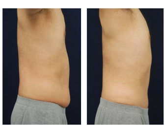 Abdominoplasty - Tummy Tuck