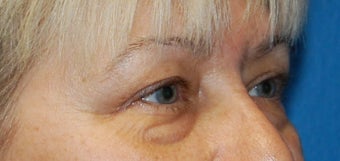 Lower Blephoplasty