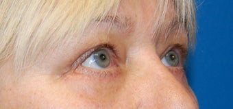 Lower Blephoplasty