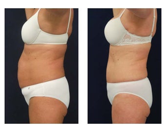 Abdominoplasty - Tummy Tuck