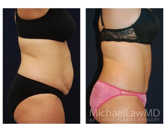 Abdominoplasty - Tummy Tuck