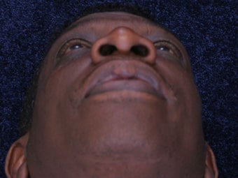 Rhinoplasty