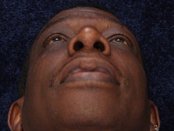 Rhinoplasty