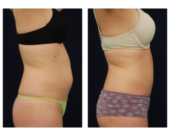 Liposuction