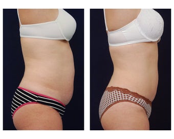 Liposuction
