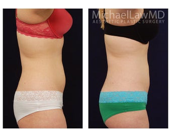 Liposuction