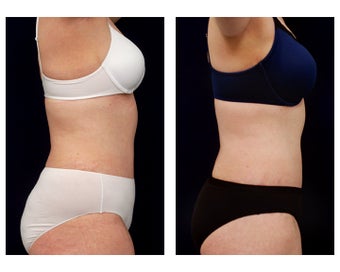 Liposuction