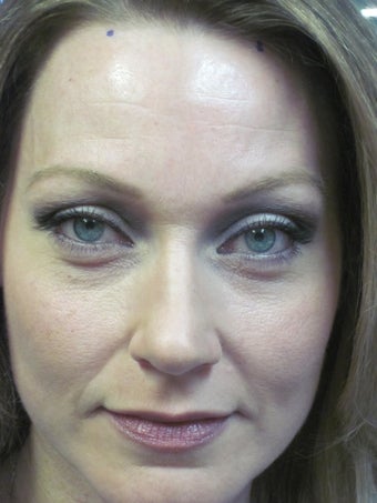 Botox