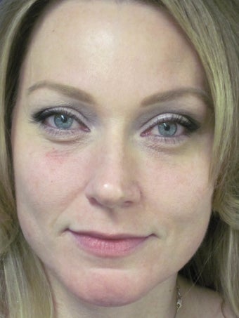 Botox