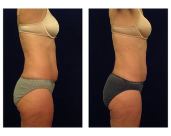 Liposuction