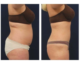 Liposuction