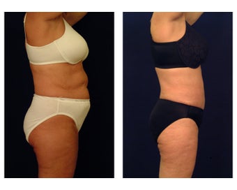 Liposuction
