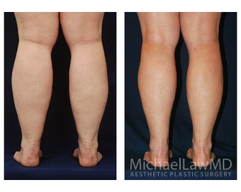 Liposuction