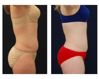 Liposuction