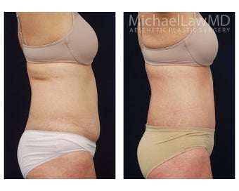 Liposuction