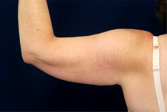 Liposuction