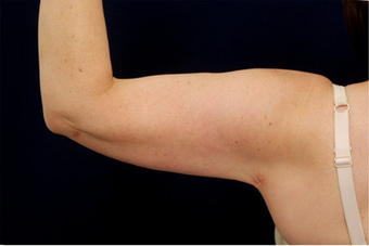 Liposuction