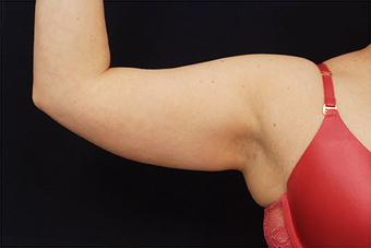 Liposuction