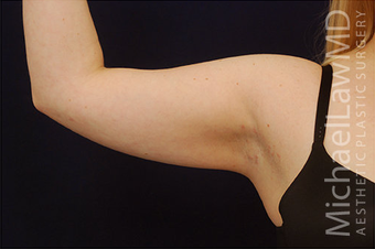 Liposuction