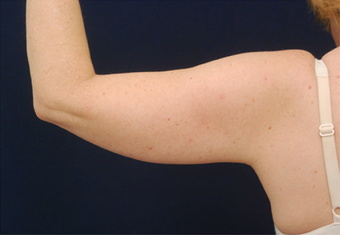 Liposuction