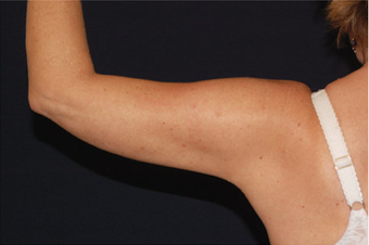 Liposuction