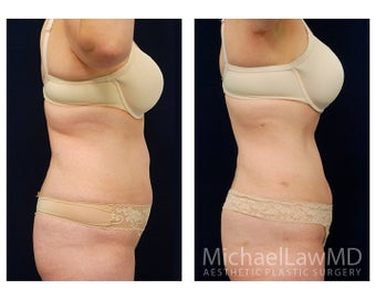 Liposuction