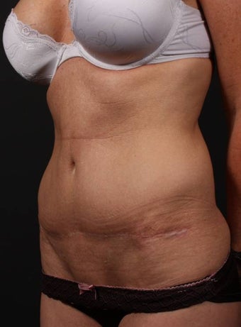 Abdominoplasty