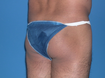 Buttock augmentation with implant