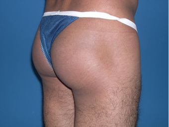 Buttock augmentation with implant