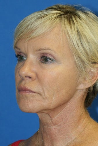 Facelift, Fat Transfer, and Skin Pinch