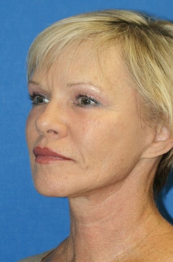 Facelift, Fat Transfer, and Skin Pinch