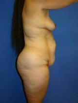 Breast Lift with Implants, Extended Tummy Tuck,