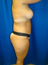 Breast Lift with Implants, Extended Tummy Tuck,