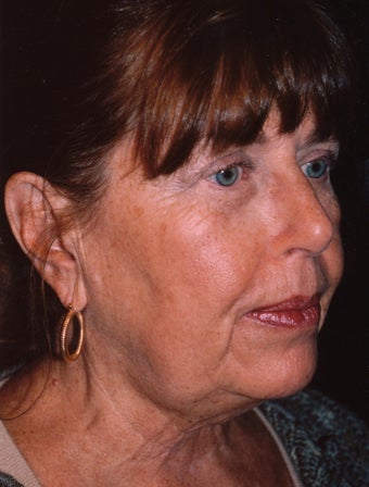 Facelift and blepharoplasty