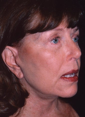 Facelift and blepharoplasty