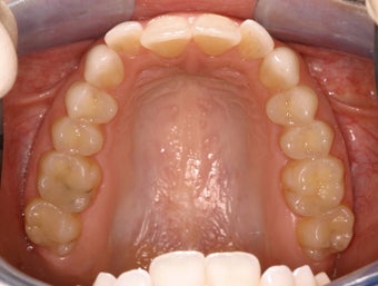Invisalign