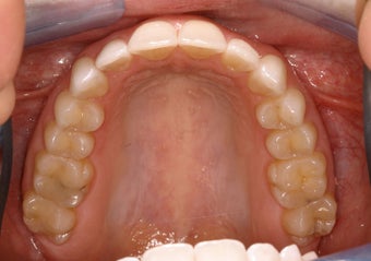 Invisalign