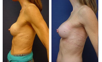 Breast implant correction