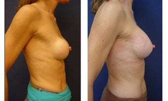 Breast implant correction