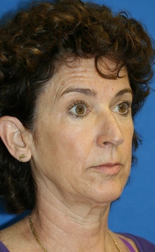 Facelift, Lateral Browlift, Fat Transfer, Chemical Peel