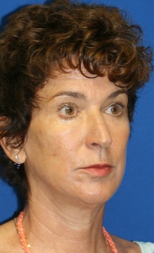 Facelift, Lateral Browlift, Fat Transfer, Chemical Peel