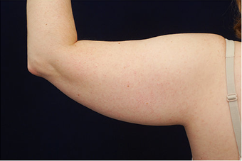 Liposuction